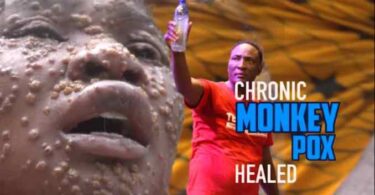 Woman Miraculously Healed Of Monkey Pox at Prophet Fufeyin’s Church [Watch Video]