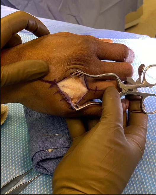 Nigerian UFC star, Kamaru Usman undergoes gruesome surgery to repair a broken hand injury (Graphic Photo)