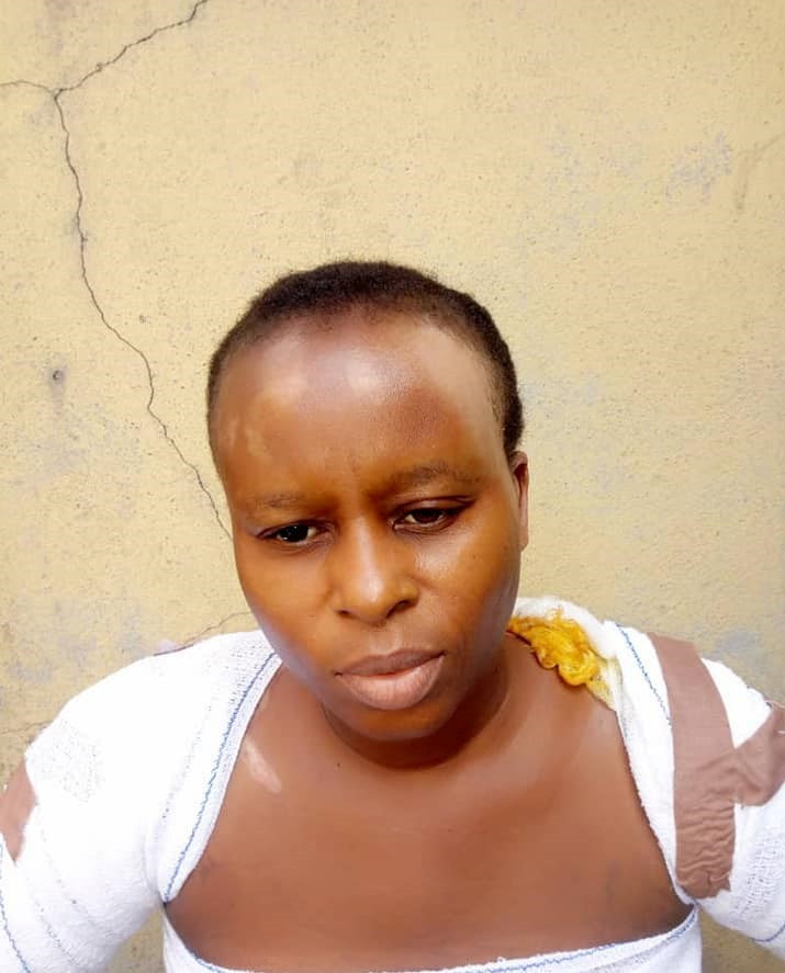 Update: Lady discharged from hospital a month after Rivers police officer allegedly scalded her with burning stove for turning down his relationship proposal 