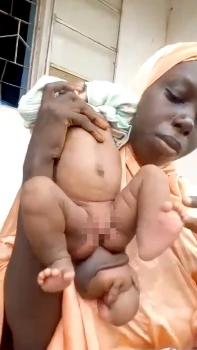 Baby born with her twin growing out of her butt (video) 